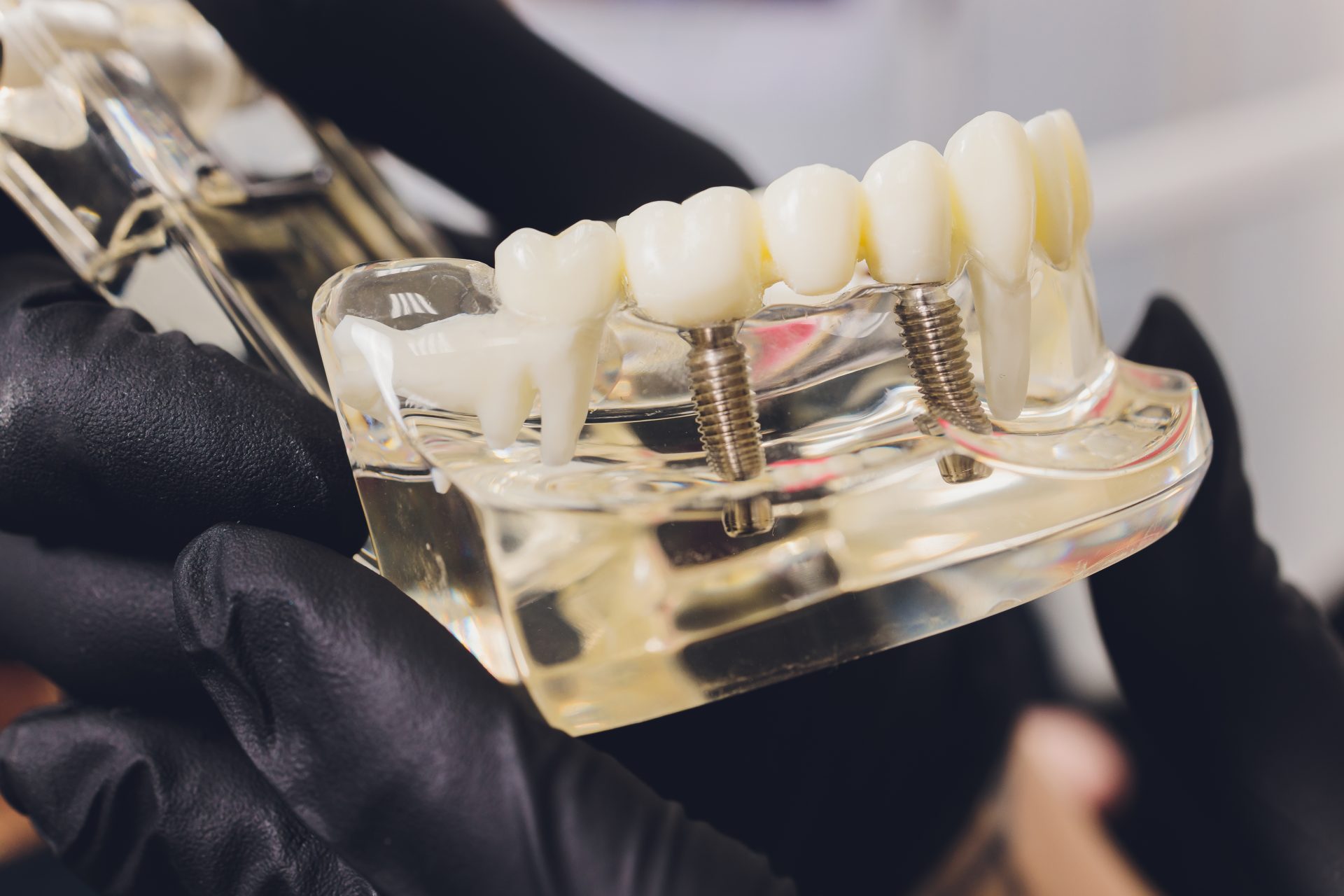 dental implants widnes dental implants widnes